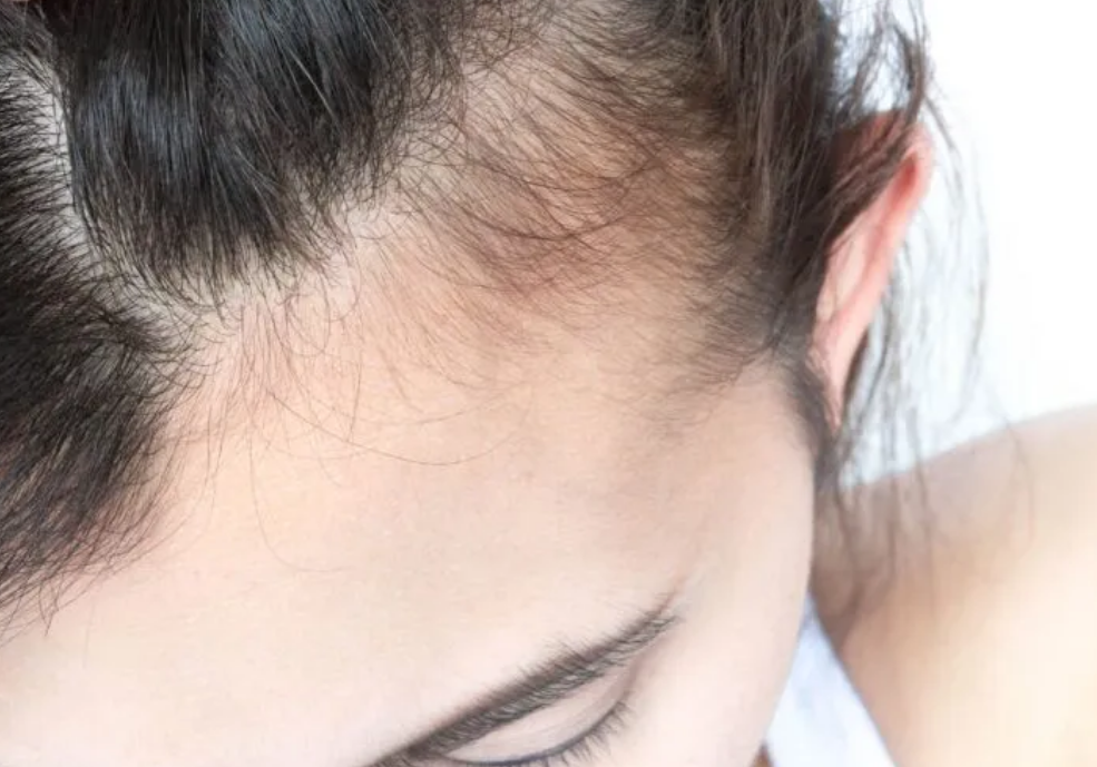 How Long Does Postpartum Hair Loss Last Hudson Dermatology And Laser 