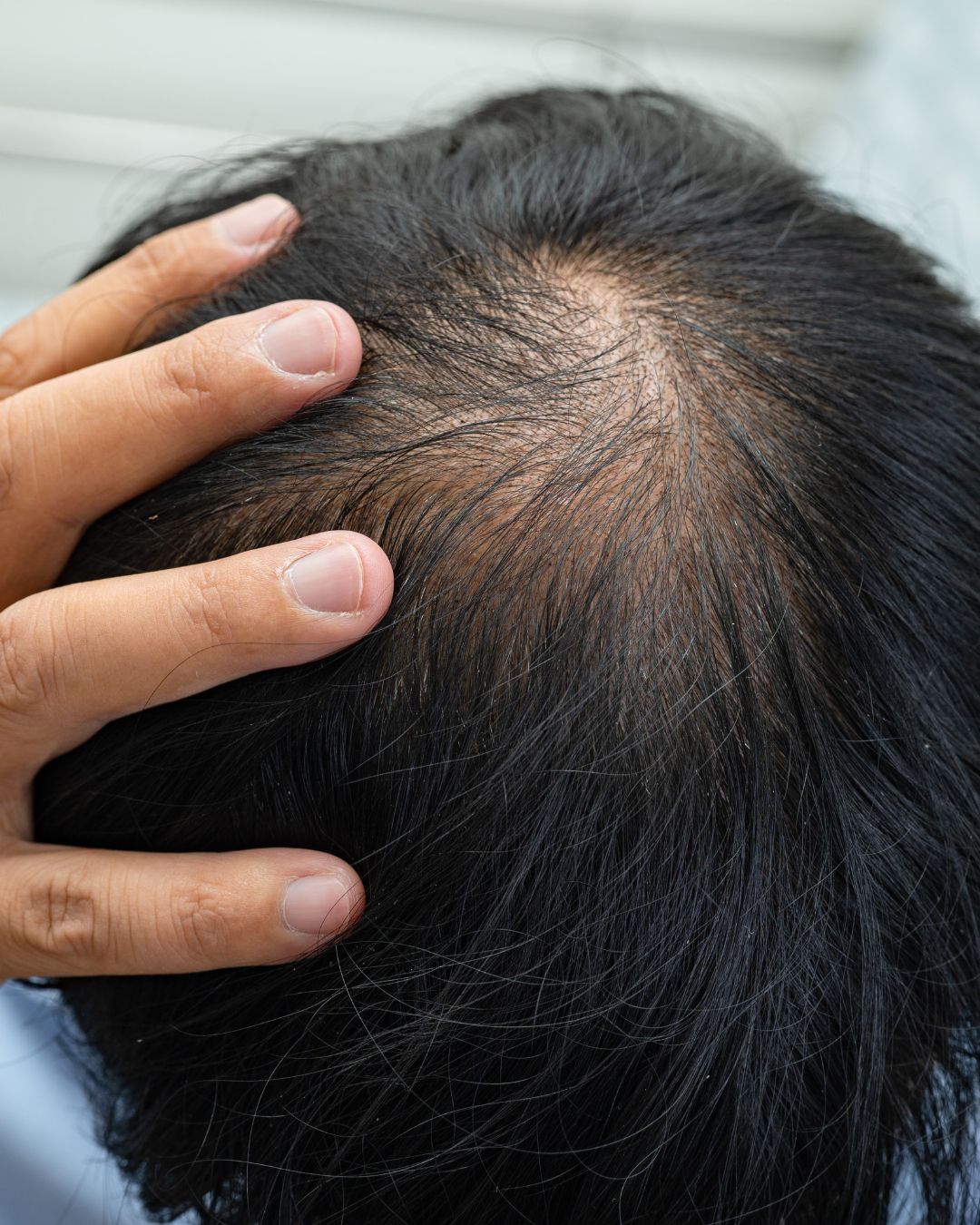 hair restoration treatments for men and women in nyc at hudson dermatology