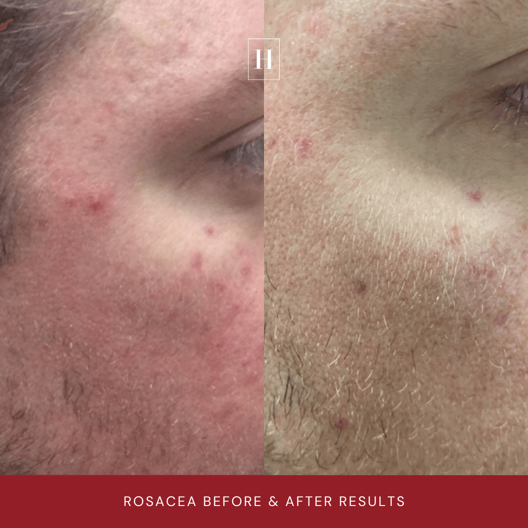 before and after redness skin treatment