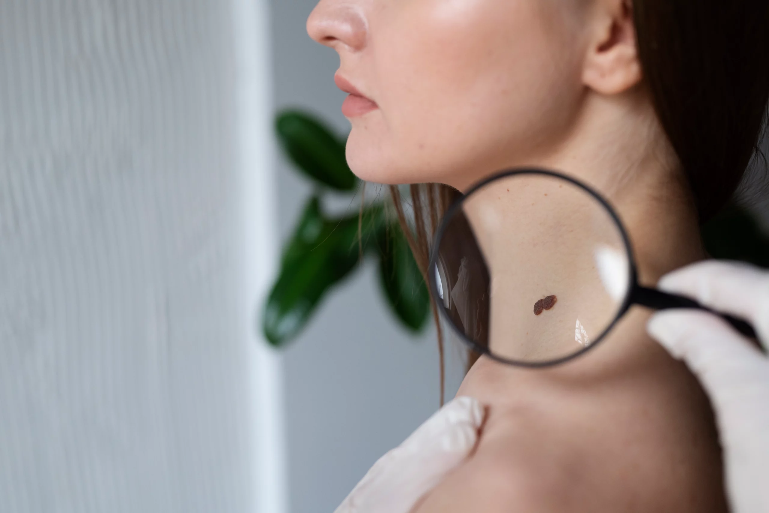 diagnosing melanoma and dangerous skin tags