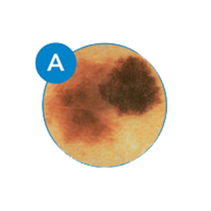 Recognizing melanoma by asymmetry