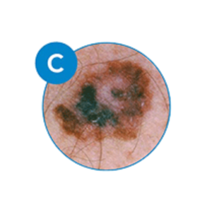 recognizing melanoma by color