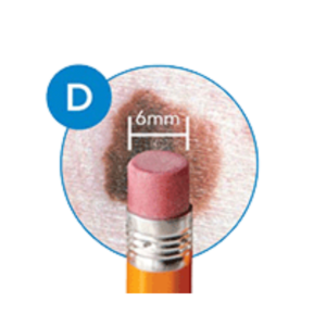 recognizing melanoma by skin spot diameter
