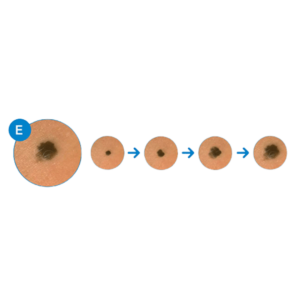 recognizing melanoma by evolution of skin mark