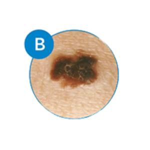 recognizing melanoma by border shape