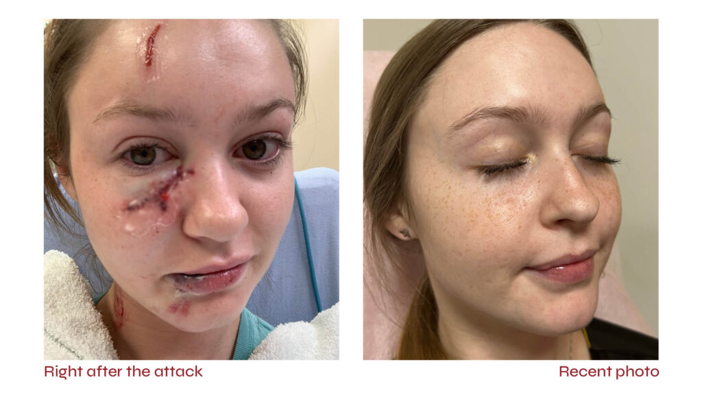 jamie harris scar treatment at Hudson dermatology and laser surgery in new york