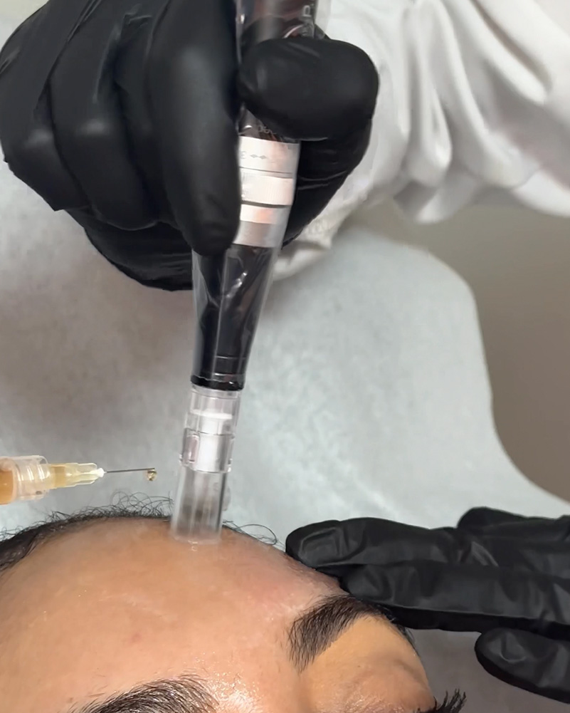 microneedling new york city