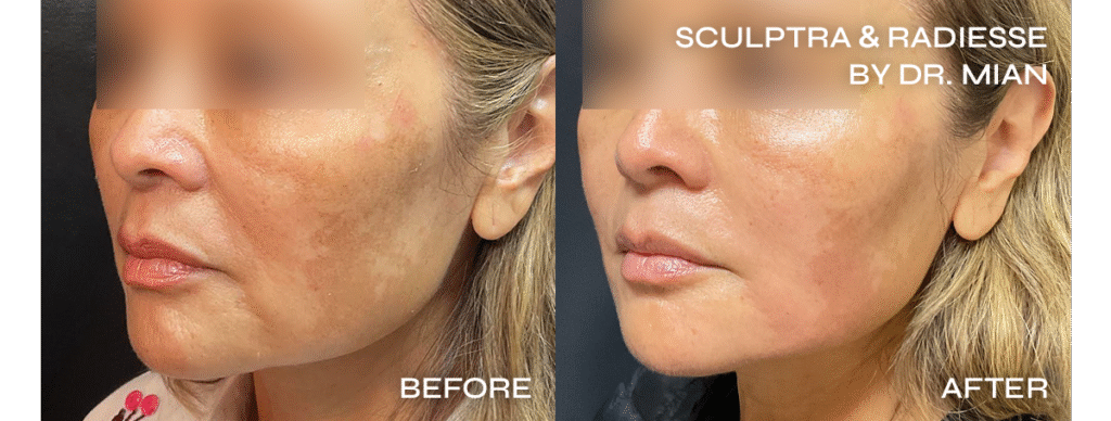 sculptra injections in new york city before and after image