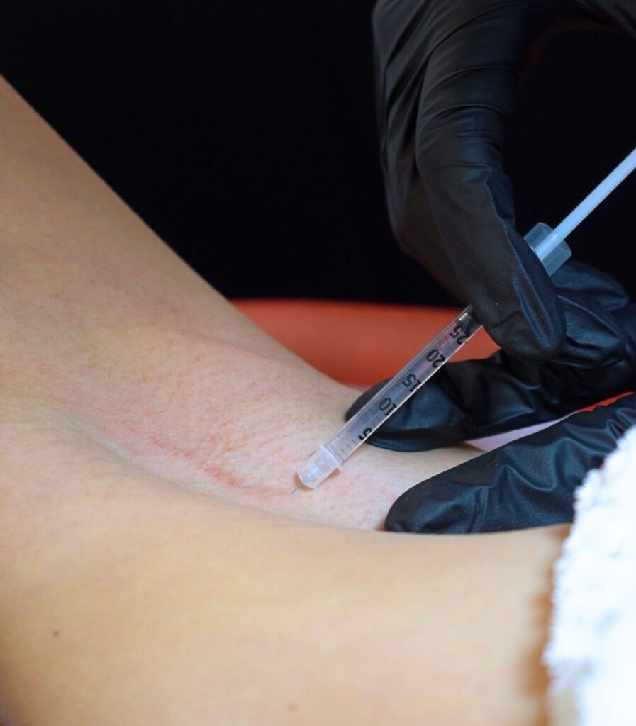 armipt botox injections for hiperhidrosis in new york city at hudson dermatology