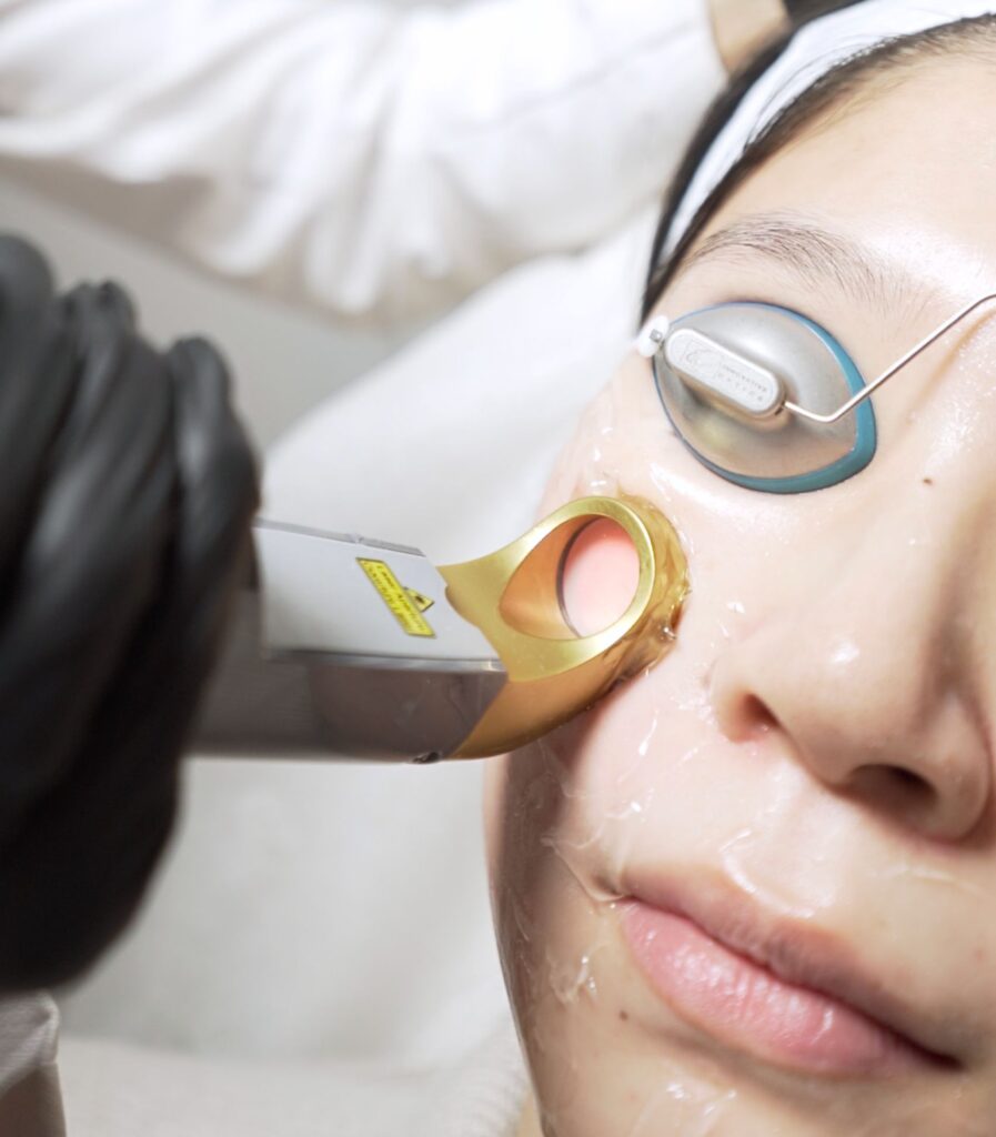 excel v laser treatment at new york city dermatologist