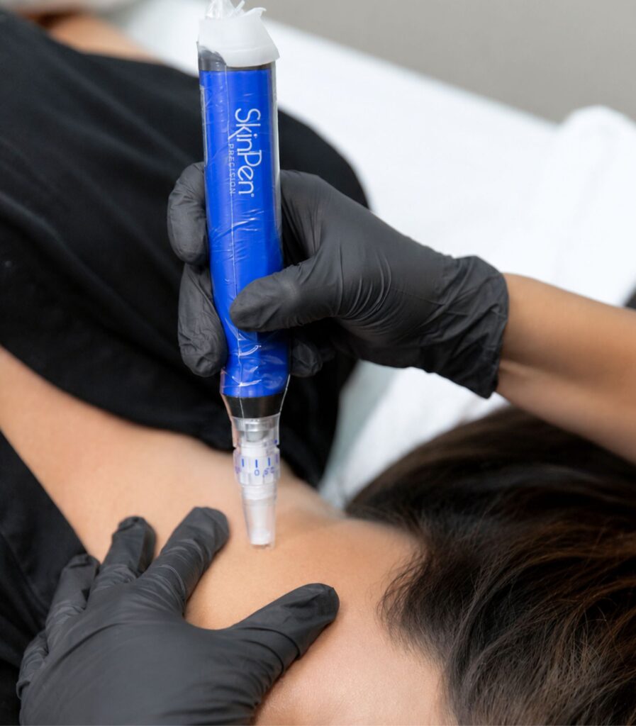 microneedling treatment in New York City at hudson dermatology and laser surgery